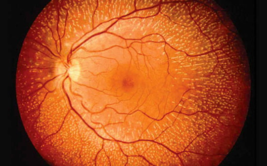 retina vista