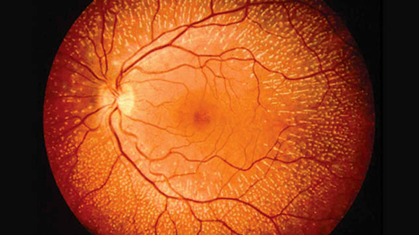 retina vista