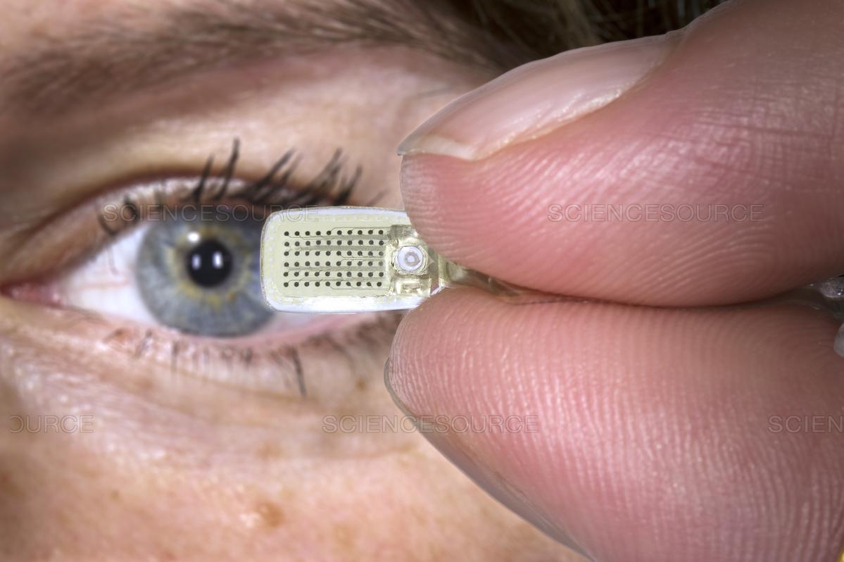 Шаман восстановил зрение слепому. Бионический имплант глаза. Аргус 2 бионический глаз. Глазной протез Argus 2. Чип зрение.
